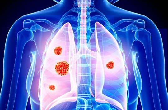 12 dấu hiệu cảnh báo ung thư phổi