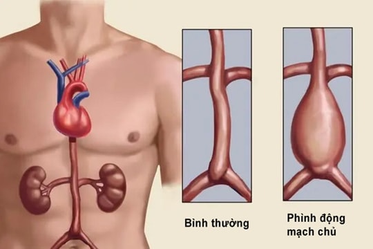 Bài kiểm tra bằng ngón tay cái phát hiện nguy cơ bệnh tim