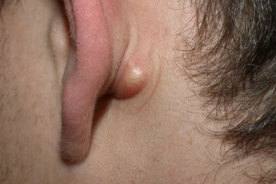Nổi hạch sau tai: Trường hợp nào là dấu hiệu ung thư