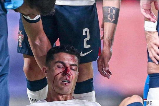 Ronaldo đổ máu sau cú đấm thẳng mặt của thủ môn CH Séc