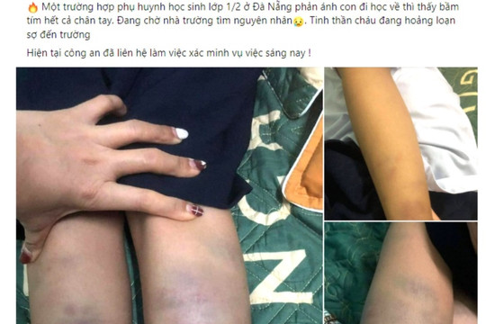Học sinh lớp 1 bị đánh bầm tím chân tay: Công an TP Đà Nẵng vào cuộc