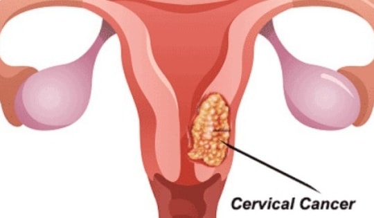 5 dấu hiệu ung thư cổ tử cung chị em nhất định không được bỏ qua