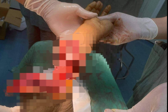 Phẫu thuật thành công trường hợp đứt gần lìa cẳng tay do bị cưa cắt