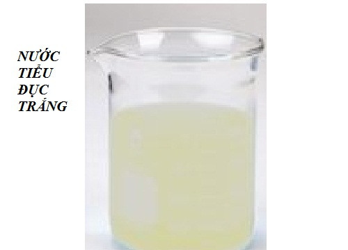 Nước tiểu trắng đục như sữa do loại ký sinh trùng có thể ở trong người hàng chục năm