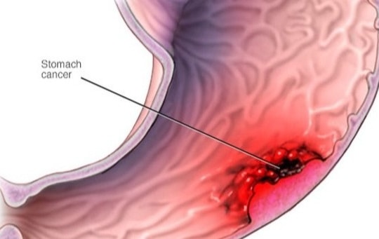 Ung thư dạ dày giai đoạn 4: Tiên lượng, các phương pháp điều trị