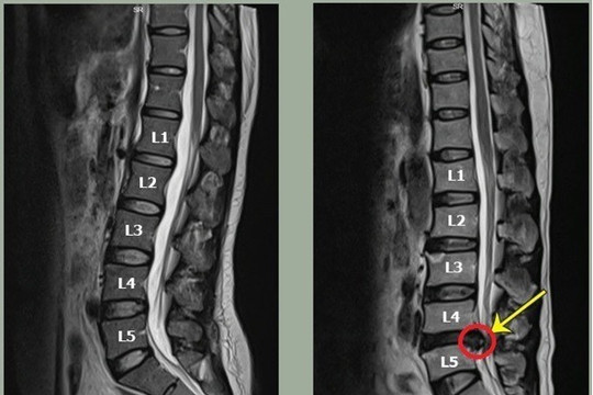 Nhiều bệnh nhân thoát vị đĩa đệm được phục hồi không cần phẫu thuật