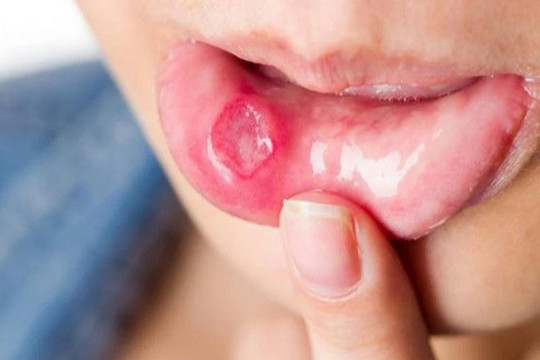 Phân biệt ung thư khoang miệng và nhiệt miệng như thế nào?