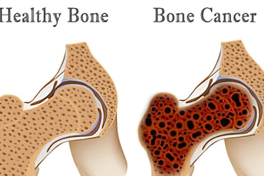 Các phương pháp điều trị ung thư xương