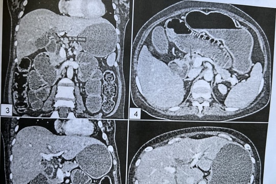 Cô gái đau bụng, nôn ói đi khám mới biết bị bệnh liệt ruột hiếm gặp