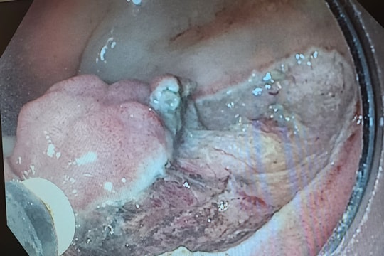 Xử lý polyp ung thư hoá trực tràng sớm, không hóa trị