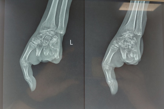 Phẫu thuật ghép ngón chân thành ngón tay cho người bệnh bị tai nạn