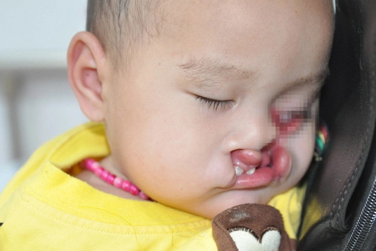 Tiếng cầu cứu của bé gái 1 tuổi dân tộc Mông mang dị tật khe hở chéo mặt