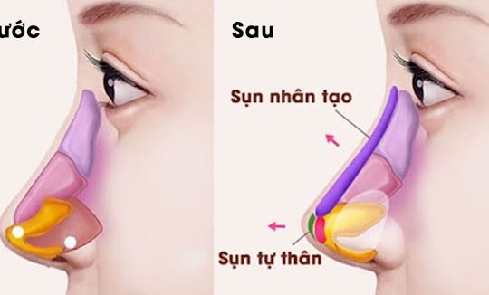 Hậu quả khi về già với những người nâng mũi: Giờ nhìn đẹp thôi, vài năm nữa mới 'thấm thía'