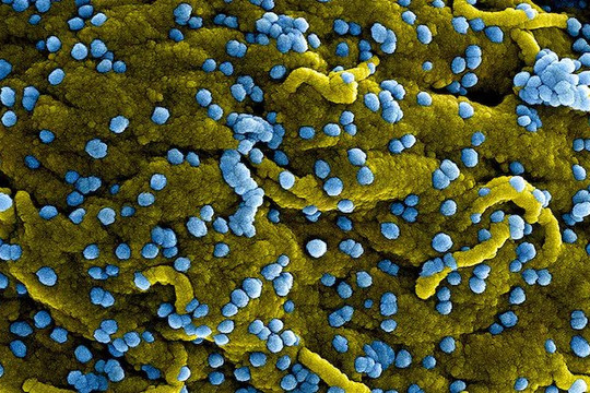 Virus Marburg gây sốt xuất huyết nguy hiểm thế nào?