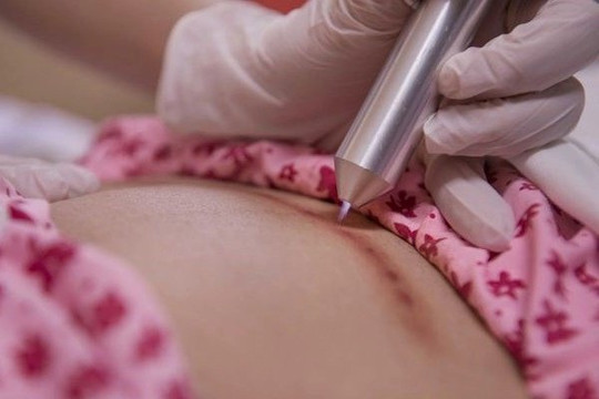 Mẹ bầu có nên chiếu tia plasma sau sinh để mau chóng hồi phục không?