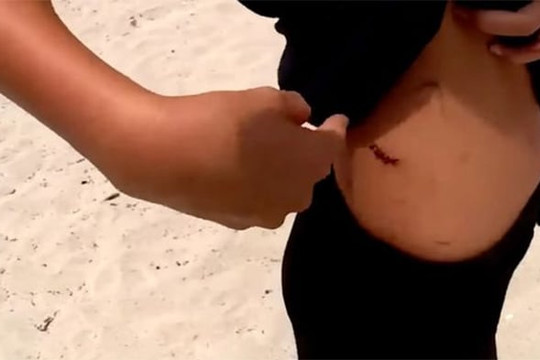 Bé gái 13 tuổi dũng cảm chiến đấu với cá mập dù bị cắn chảy máu