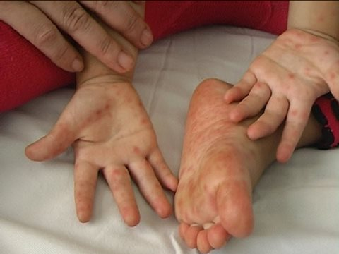 Một trẻ tử vong do tay chân miệng, Sở Y tế TP.HCM triển khai các giải pháp gì