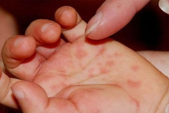 Bộ Y tế: 40% trẻ mắc tay chân miệng do chủng virus nguy hiểm