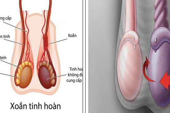 Chàng trai mất một bên tinh hoàn chỉ vì chủ quan