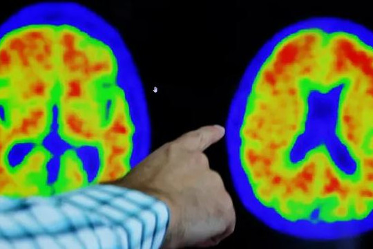 Thuốc donanemab - đột phá trong việc điều trị bệnh Alzheimer