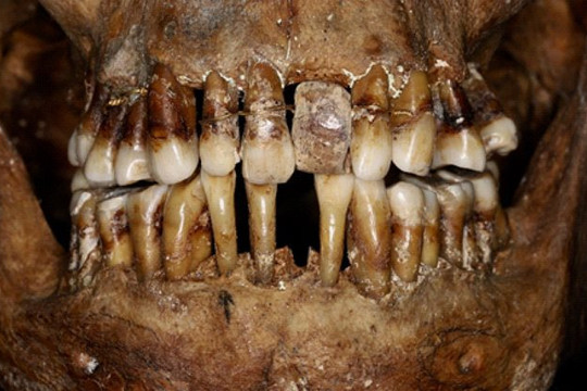 Hàm răng của người phụ nữ được bảo quản sau hơn 400 năm