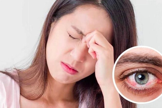 Cảnh báo dịch đau mắt đỏ lây lan nhanh, nhiều trẻ biến chứng nặng