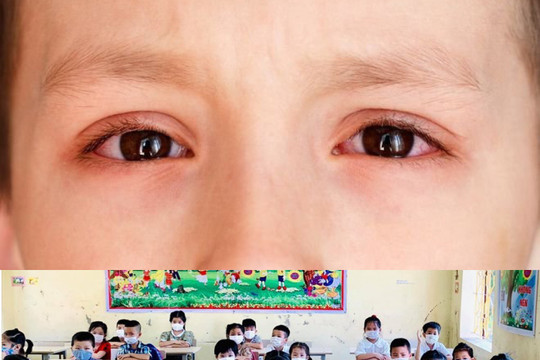Học sinh bị đau mắt đỏ cần nghỉ học, tránh lây lan trong trường học