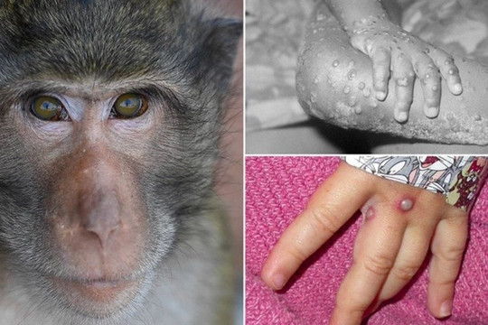 TPHCM phát hiện thêm 1 trường hợp mắc bệnh đậu mùa khỉ