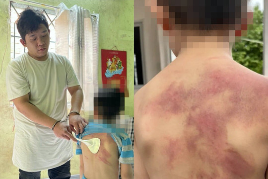 Bé trai 5 tuổi ở Đồng Nai bị cha ruột đánh dã man