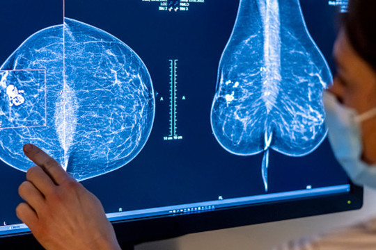 Thời điểm phụ nữ nên đi khám sàng lọc để sớm phát hiện ung thư vú