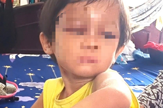 Bé gái 4 tuổi nghi bị cha nuôi bạo hành