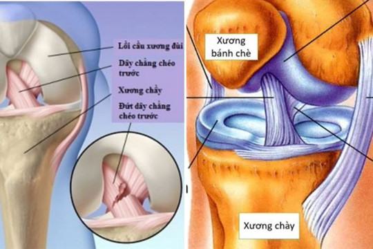 Dấu hiệu khớp gối bị đứt dây chằng khi sinh hoạt, tập luyện