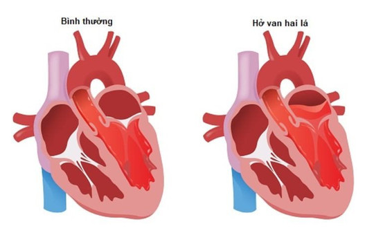 Hở van tim mạch có thể chữa khỏi bằng thuốc không?
