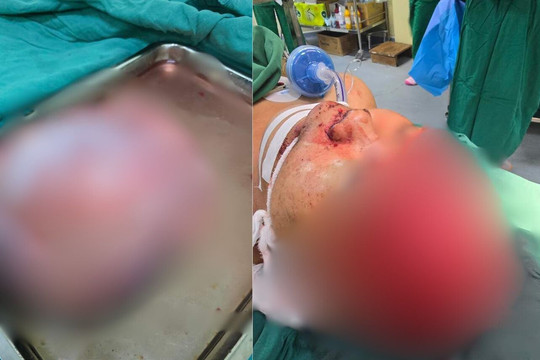 Nam thanh niên ở Kon Tum bị tai nạn, lóc da đầu trong lúc sửa ôtô
