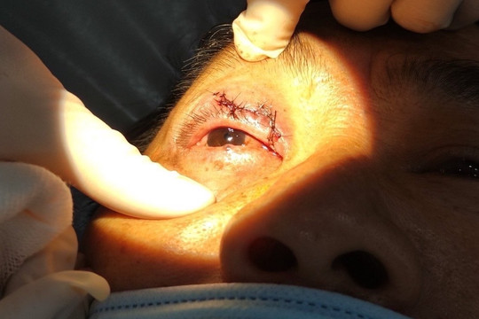 Sửa chuồng gà, người đàn ông ở Hậu Giang bị kẽm B40 đập vào gây rách mi mắt