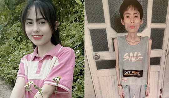Cô gái Hưng Yên nặng 18kg sau nhiều năm không ăn cơm để giảm cân