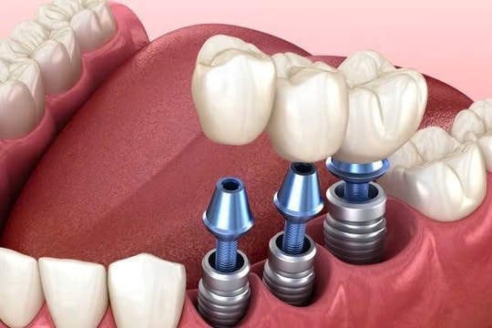 Bệnh viện Răng Hàm Mặt Sài Gòn - Địa chỉ trồng răng Implant uy tín