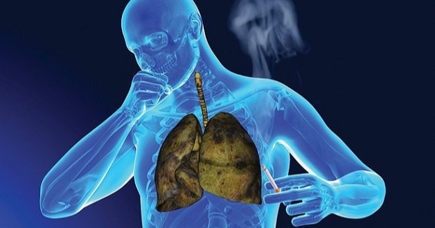 Các yếu tố nguy cơ dẫn đến ung thư phổi không tế bào nhỏ