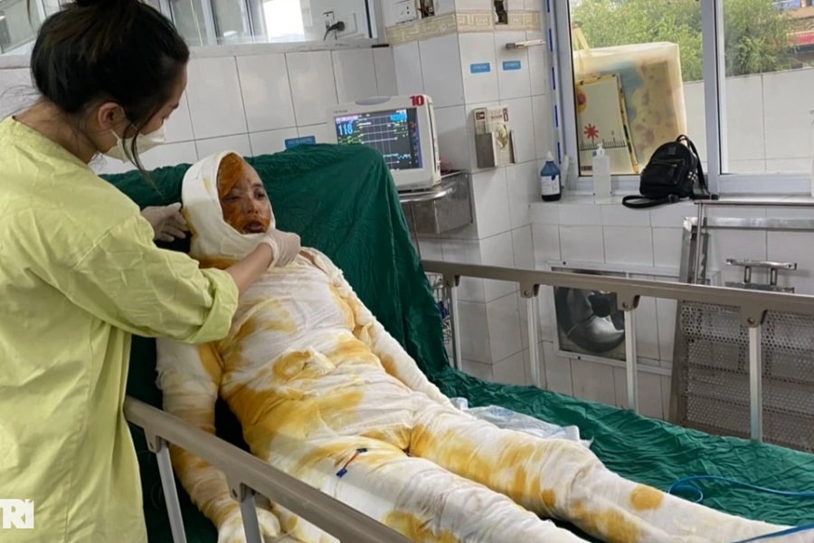 Xót xa gia cảnh vợ chồng người nông dân bị bỏng do dùng xăng đốt rơm