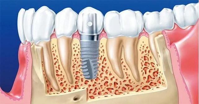 Lịch sử ra đời và phát triển của những chiếc răng giả