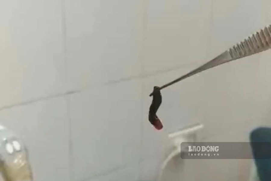 Quảng Ninh: Phát hiện vắt dài 2cm sống trong hốc mũi bệnh nhân