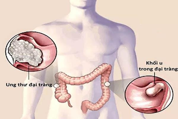 7 đối tượng có nguy cơ mắc ung thư đại trực tràng