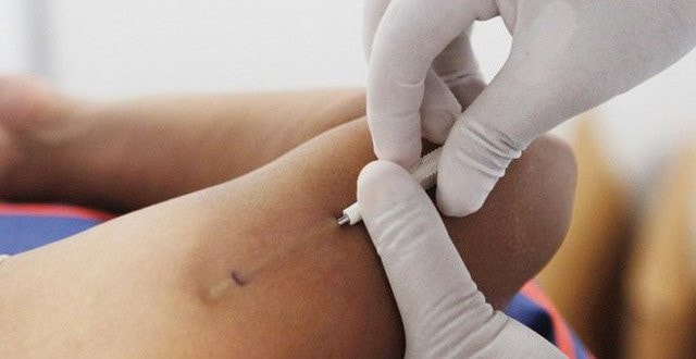 Cấy que xếp đầu bảng trong các phương pháp tránh thai, tác dụng phụ như thế nào?