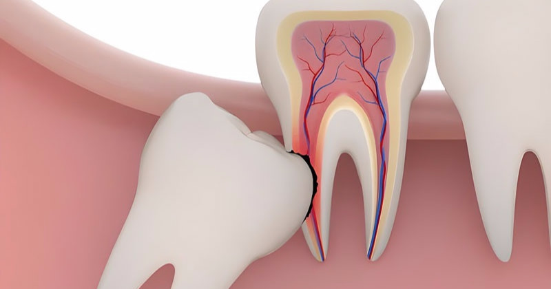 Nhổ răng khôn có được hưởng bảo hiểm y tế không?