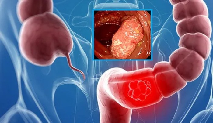 Cho con đi viện cấp cứu vì đau bụng, bố mẹ sốc khi bác sĩ chẩn đoán ung thư