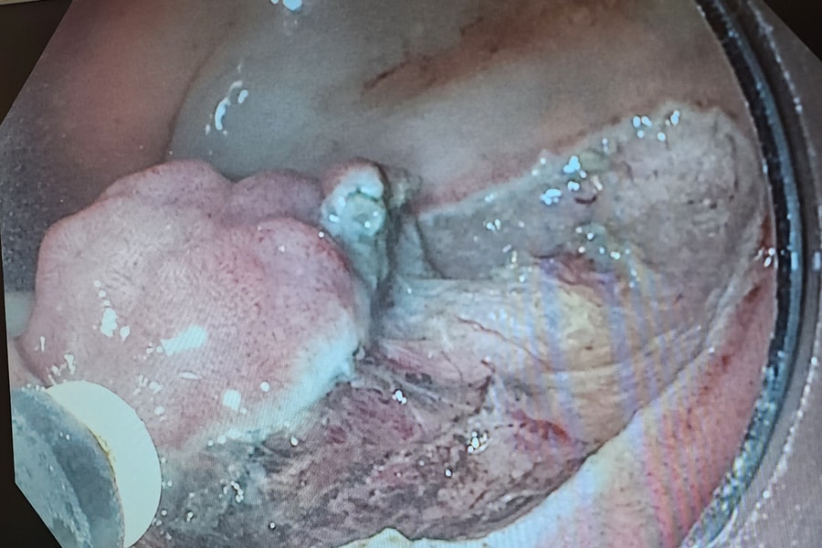 Xử lý polyp ung thư hoá trực tràng sớm, không hóa trị