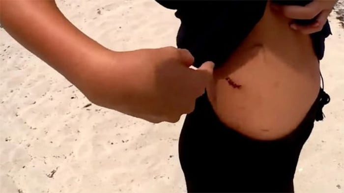 Bé gái 13 tuổi dũng cảm chiến đấu với cá mập dù bị cắn chảy máu