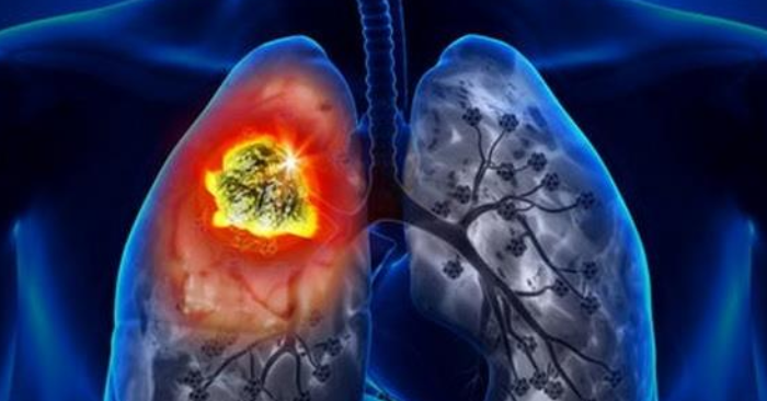 Phát hiện ung thư phổi di căn từ triệu chứng đau lưng