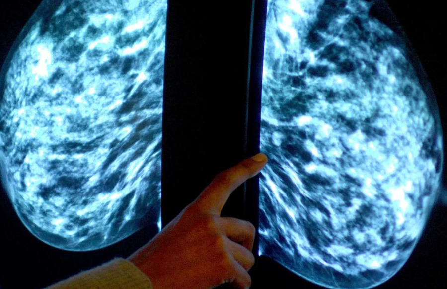 Phụ nữ cao tuổi chụp X-quang tuyến vú dễ bị chẩn đoán quá mức
