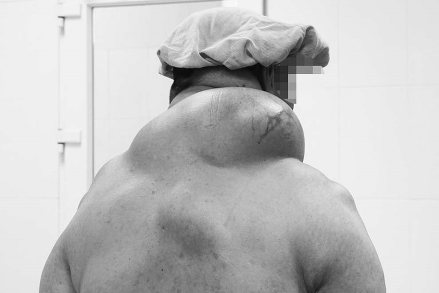 Giải phẫu khối u nặng gần 1,5 kg sau gáy bệnh nhân ở Quảng Ninh